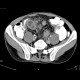 Mesenteric abscess, Crohn's disease: CT - Computed tomography